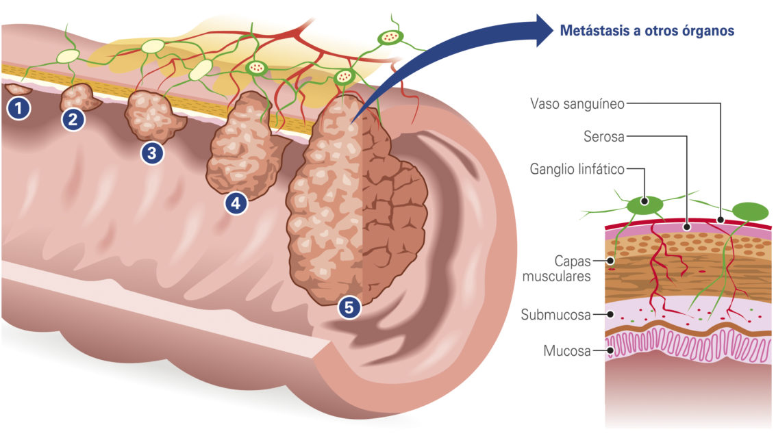 ¿Cómo detectar a tiempo un cáncer de colon? - Fundación Arturo López Pérez